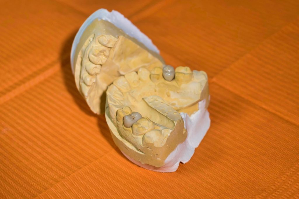Dental lab model showing crown restorations on prepared teeth against an orange background